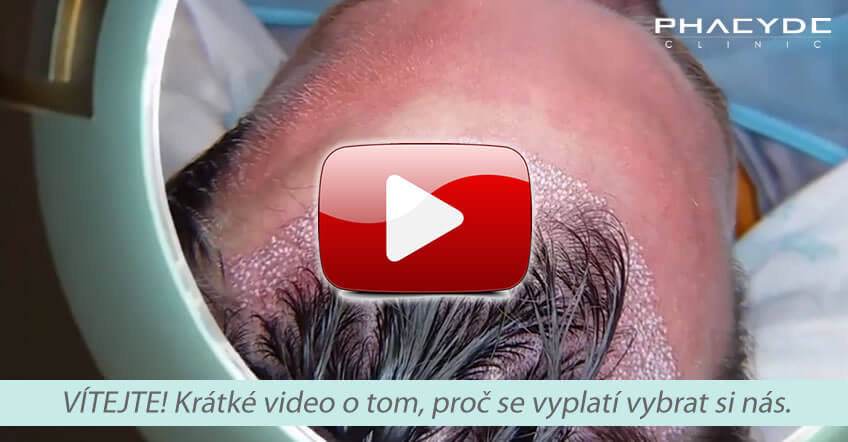  PHAEYDE
                                    Hair Transplantation Sale 