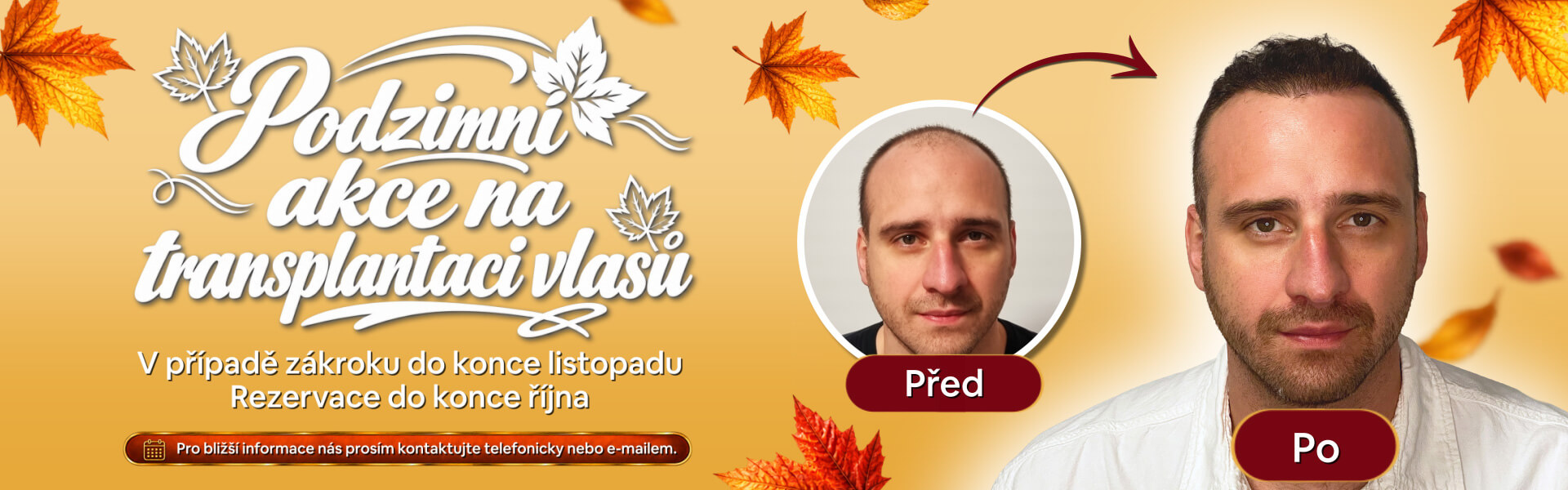 Podzimní akce na transplantaci vlasů - PHAEYDE Clinic Praha