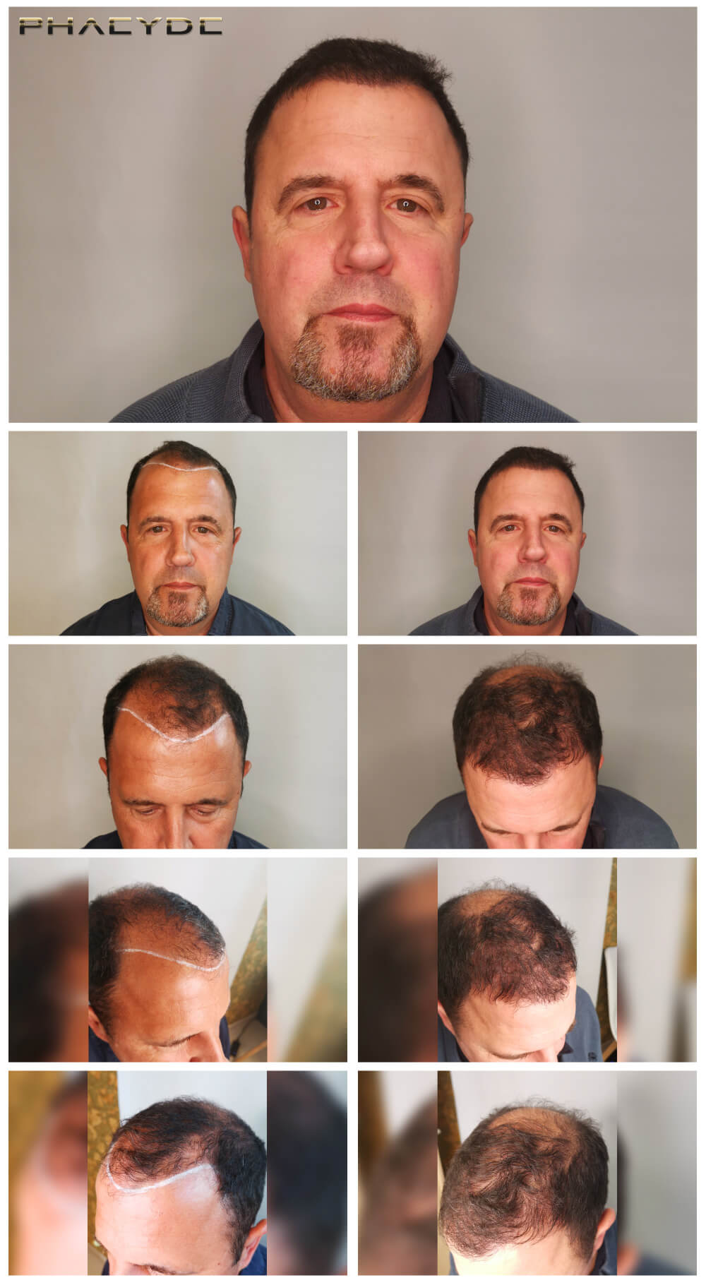 Günther – 2800  štěpů